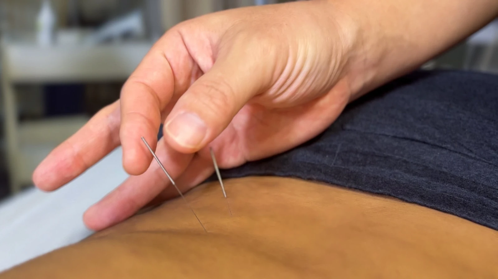 Acupuncture treatment at Cha Physical Therapy